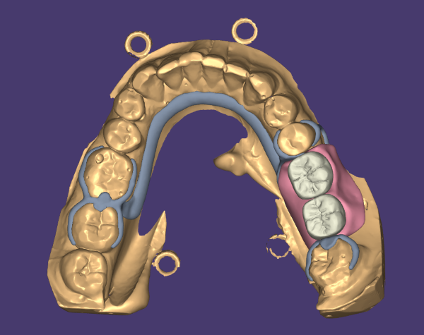 Cast Partial Design Service