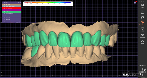 CROWN & BRIDGE DESIGN - DIGITAL DENTAL DESIGN SERVICES